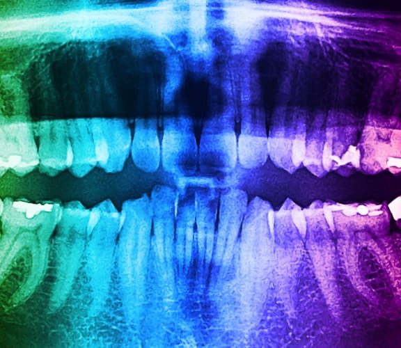 Full mouth x-ray
